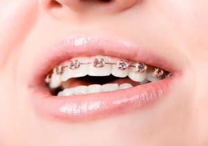 Aparat ortodontyczny